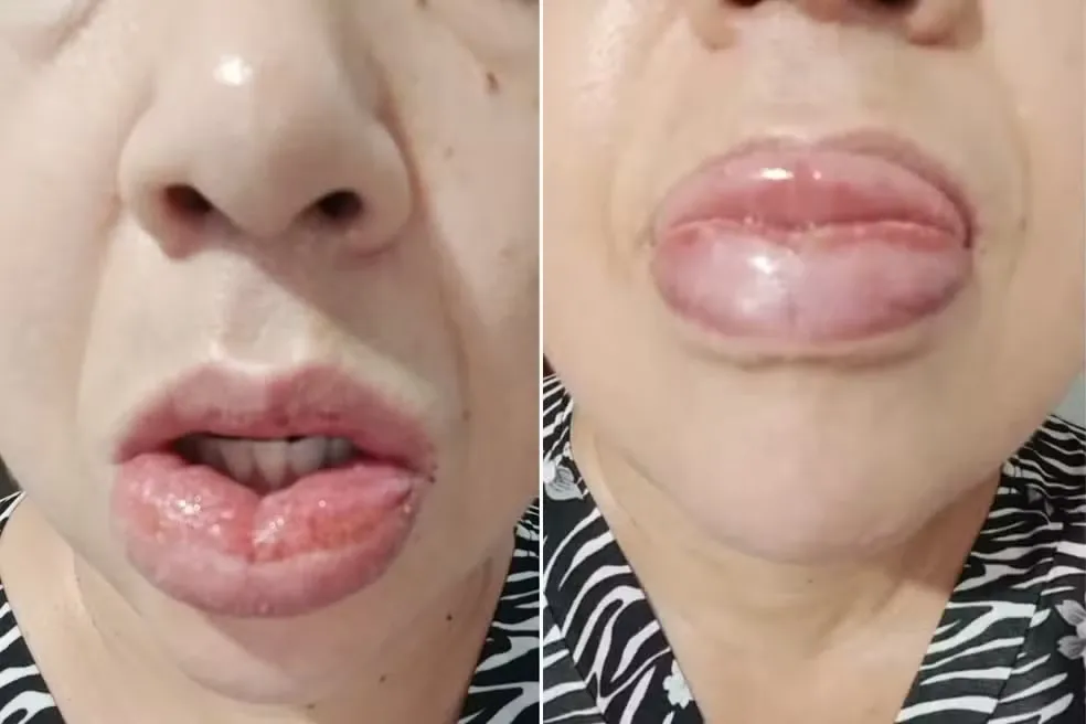 Mulher de 45 anos, morador do interior de São Paulo, sofreu reação alérgica à pasta de dente - Foto: Reprodução/Especial