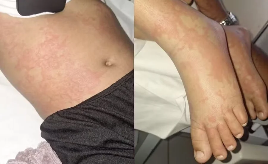 A família informou que guardou a embalagem do produto utilizado na residência para que ele seja recolhido e submetido a análises laboratoriais de contraprova. (Foto: Reprodução)
