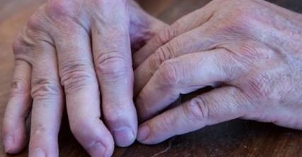 Por que tratar precocemente a artrite reumatoide?