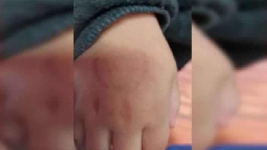 Diretora de escola é investigada por morder criança de 4 anos em Tenente Portela