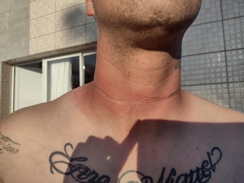 Motociclista quase é degolado por fio de internet em Bento Gonçalves