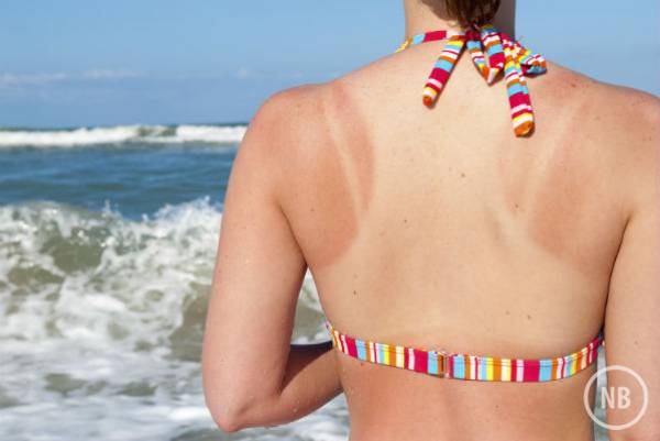 Os cuidados com a pele queimada pelo Sol