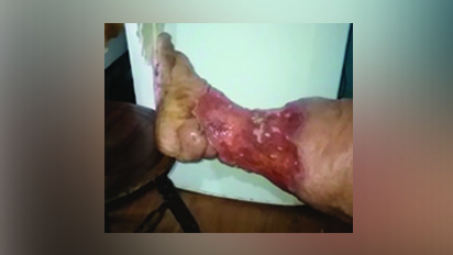 Viviane está há sete anos aguardando atendimento adequado para sua úlcera crônica em uma das pernas. Crédito: Arquivo Pessoal