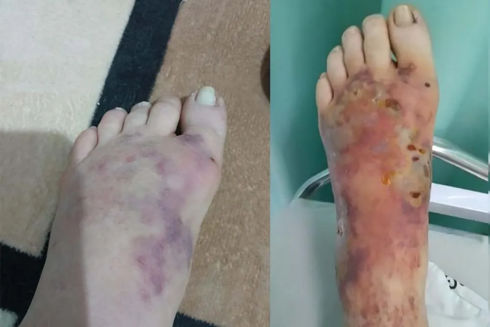 Maria Natalina entrou com o pé apenas inchado e agora corre o risco de tê-lo amputado - Foto: Divulgação